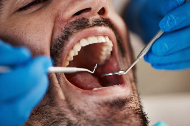 Best Emergency Wisdom Teeth Removal in Trenton, MO