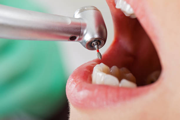 Best Emergency Root Canal Treatment in Trenton, MO